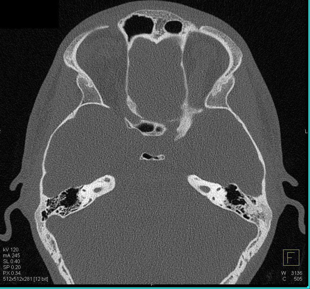 Maxillary Sinusitis - CTisus CT Scan