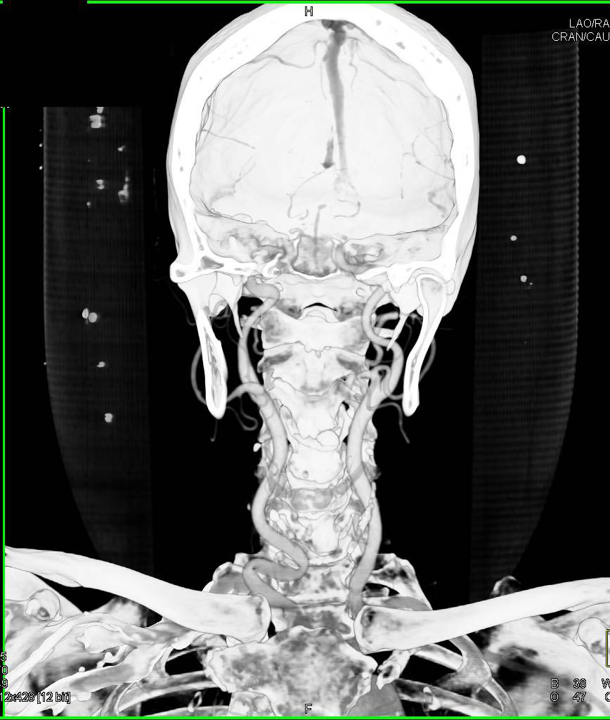 CT Angiography of the Carotid and Cerebral Circulation With Single Energy CT with Bone Removal Compared with Dual Energy CT with Bone Removal - CTisus CT Scan