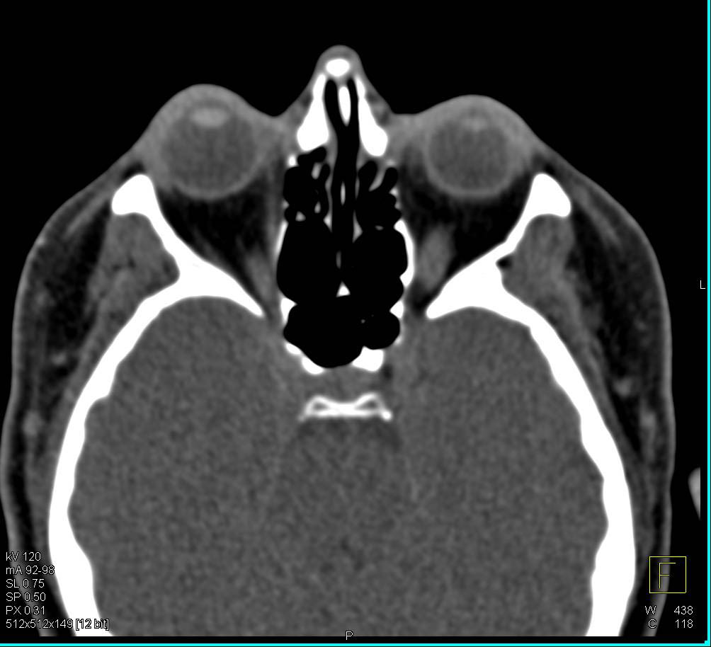 Mild Sinusitis - CTisus CT Scan