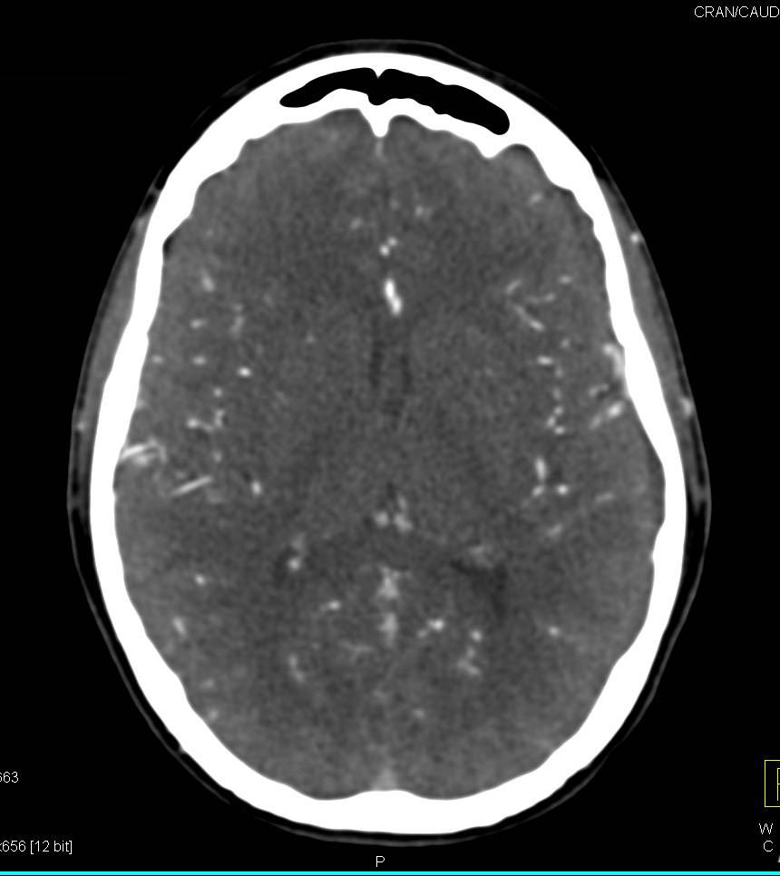 CTA of the Brain - CTisus CT Scan