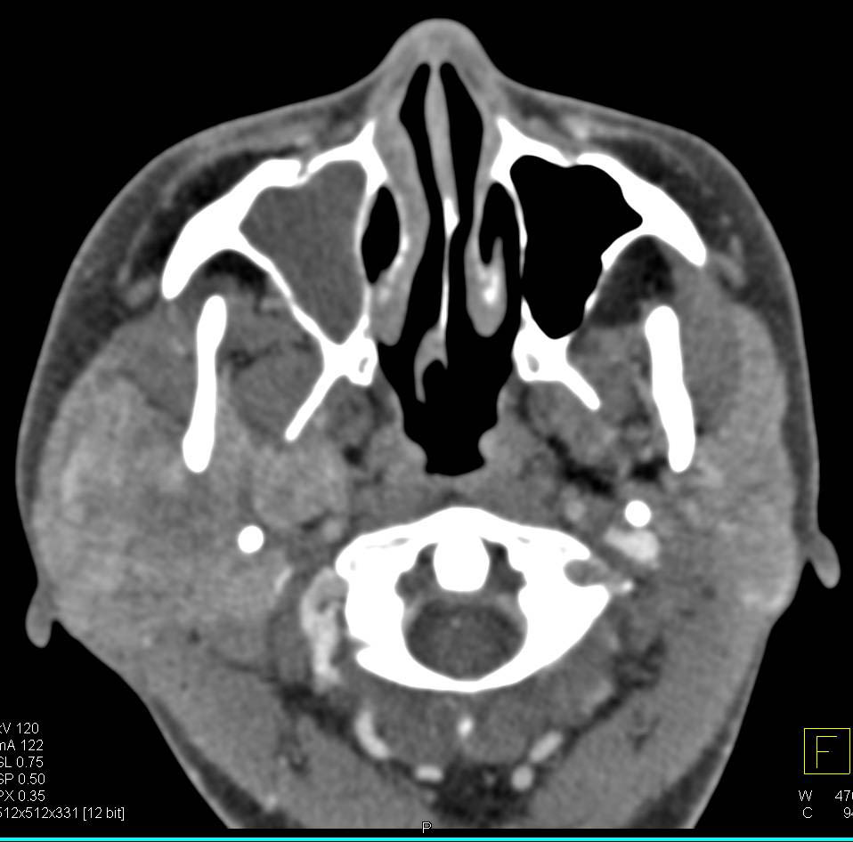 Pleiomorphic Carcinoma of the Parotid Gland - CTisus CT Scan