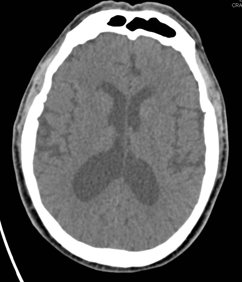 Hydrocephalus - CTisus CT Scan