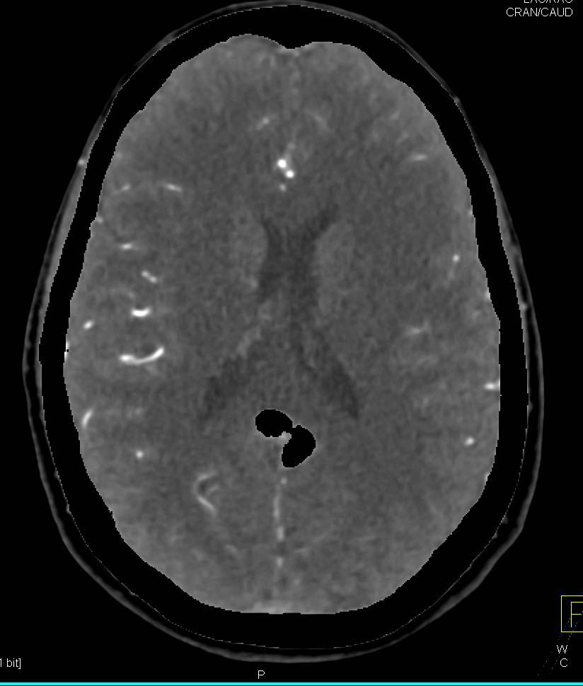 Dual Energy Brain CTA - CTisus CT Scan