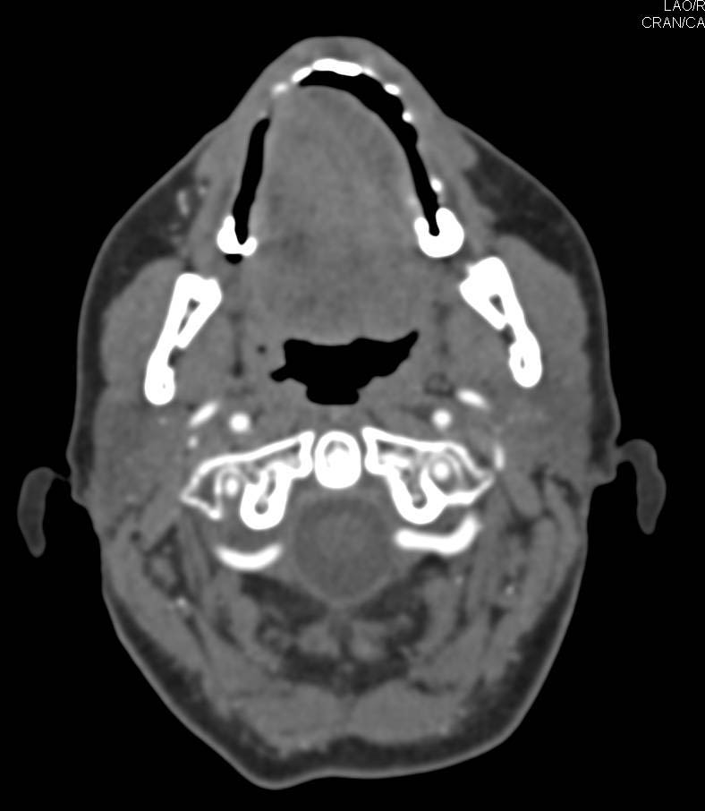 Normal Neck Ct Scan