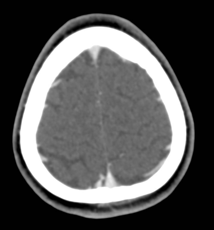 Arteriovenous (AV) Fistulae in the Brain - CTisus CT Scan