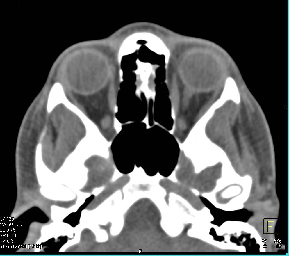 High Resolution Imaging of the Orbits and Sinuses - CTisus CT Scan