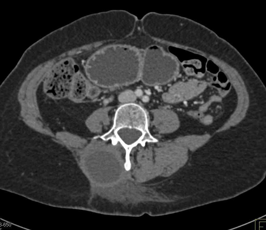 Large Paraspinal Abscess - CTisus CT Scan