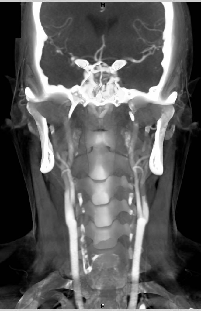 Ectatic Carotid Arteries in a Marfan Patient - CTisus CT Scan