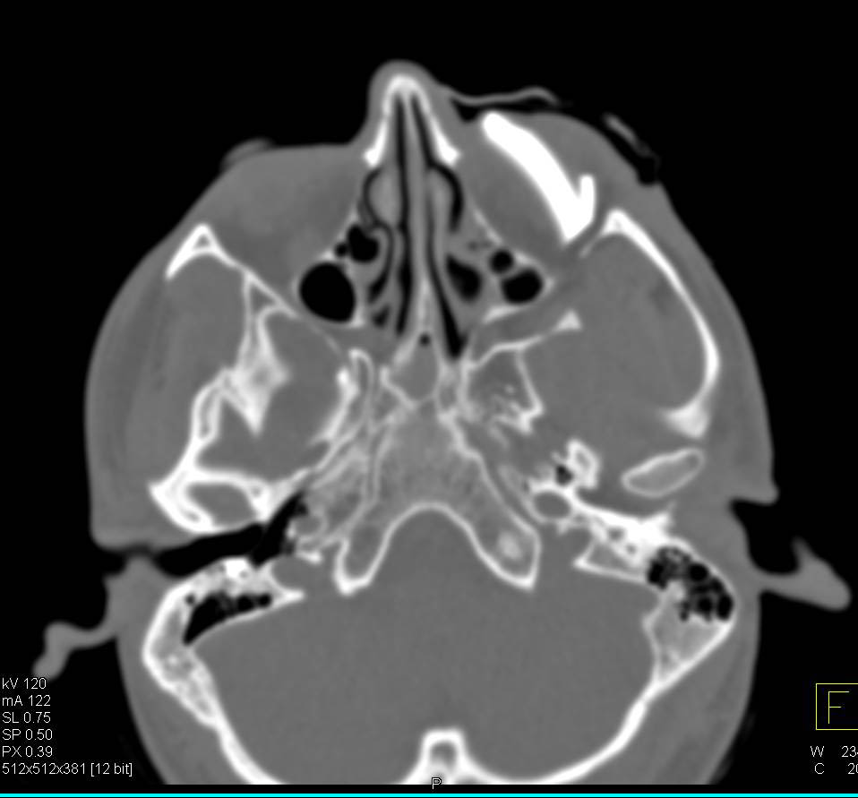 Orbital Fracture with Multiple 3D Images - CTisus CT Scan