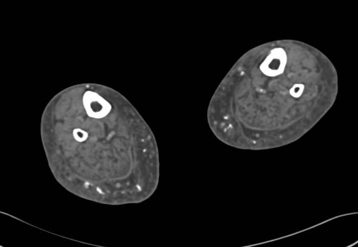 Soft Tissue Calcification in a Patient with Chronic Renal Disease - CTisus CT Scan