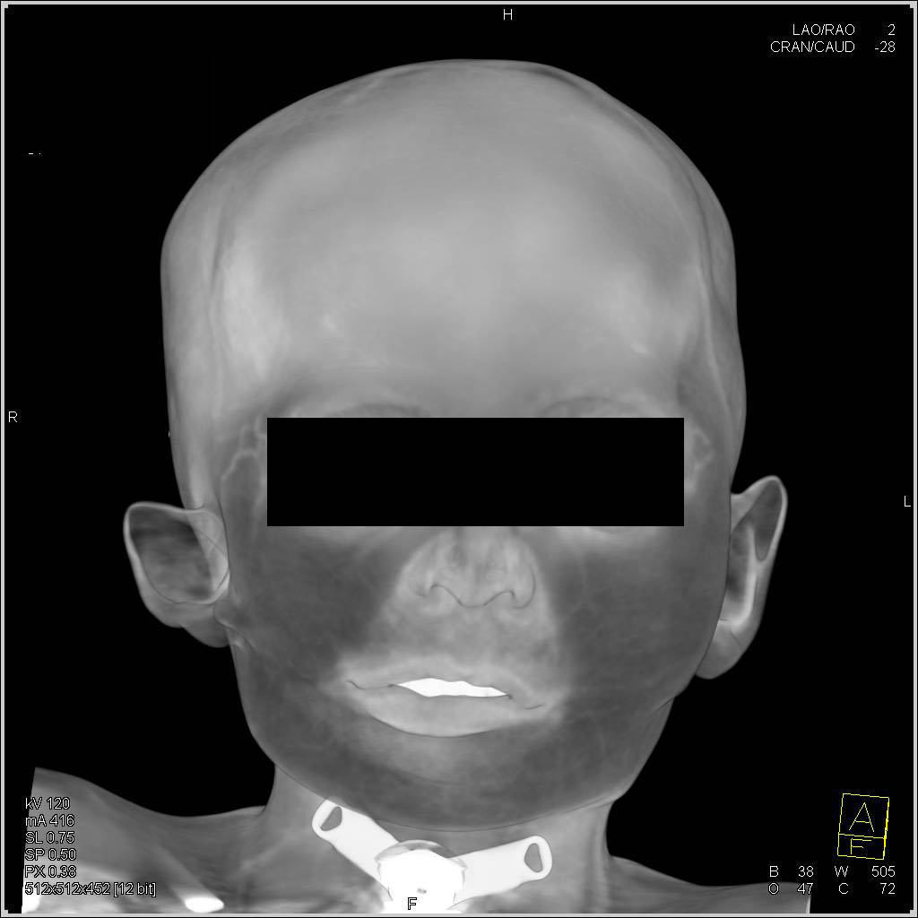 3D VRT Renderings of Craniofacial Deformity - CTisus CT Scan