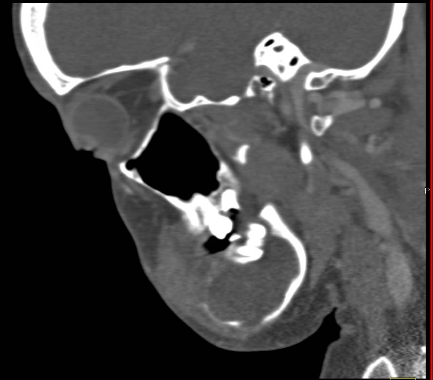 Cystic Tumor of the Mandible was a Ameloblastoma - CTisus CT Scan