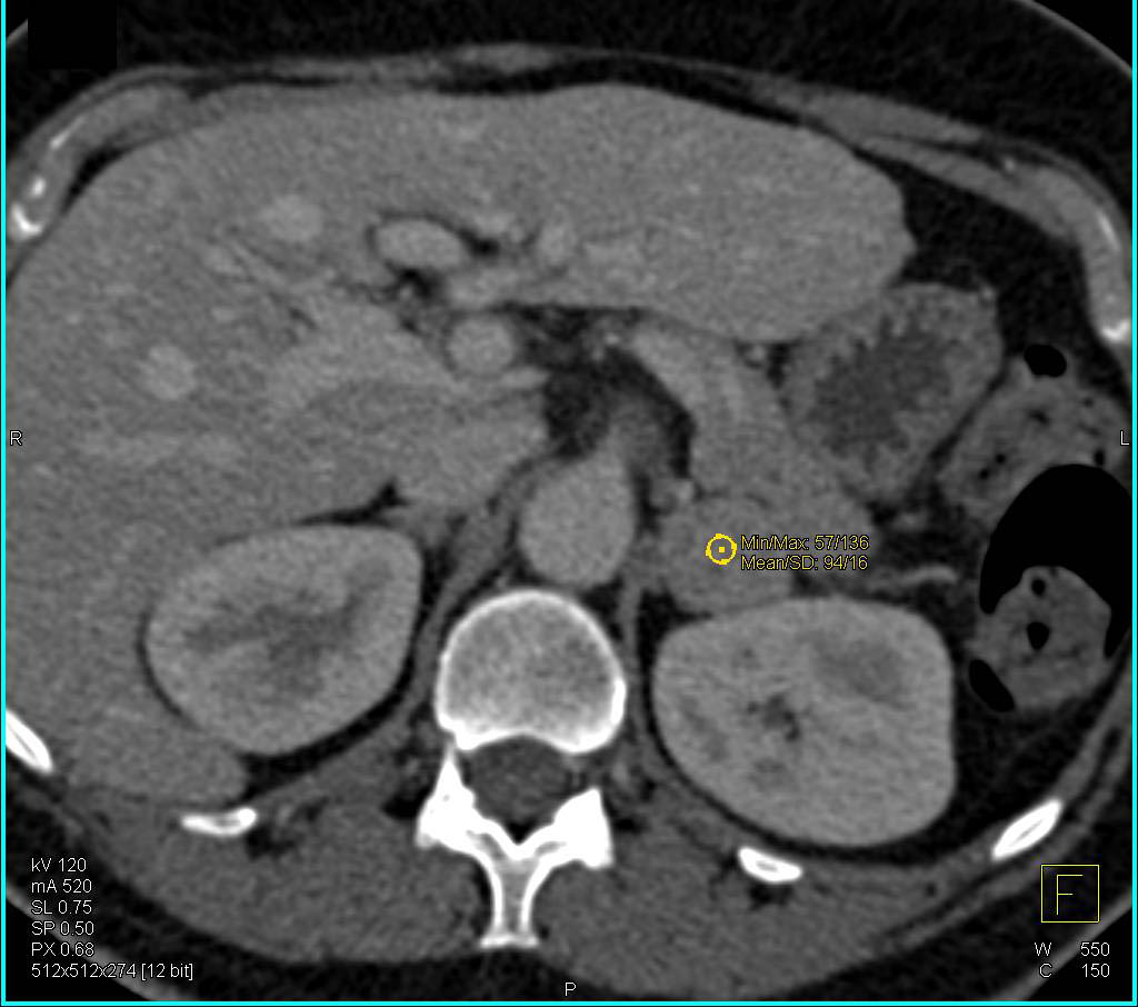 Carotid Body Tumor and Bilateral Pheochromocytomas - CTisus CT Scan