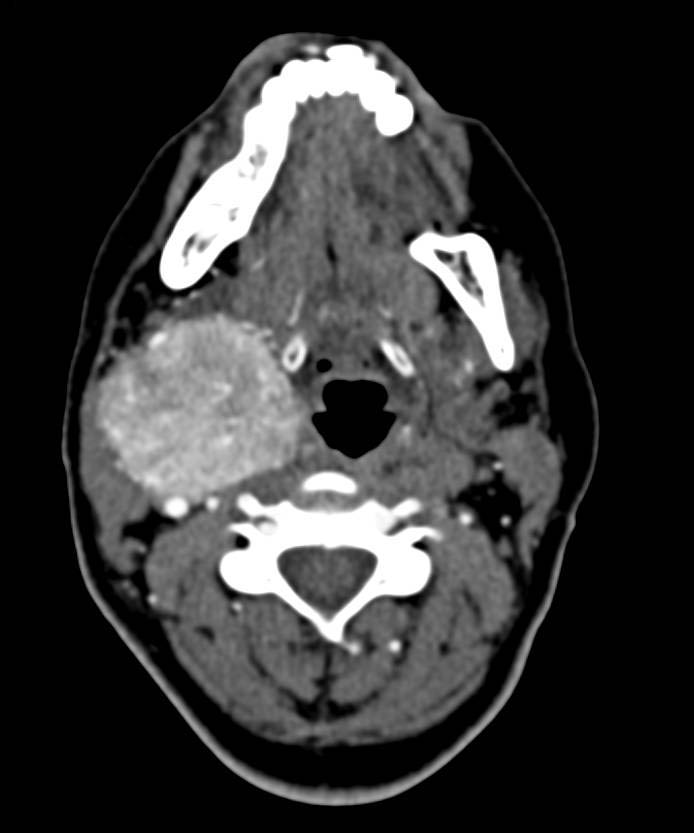 Right Carotid Body Tumor and Left Adrenal Pheochromocytoma - CTisus CT Scan