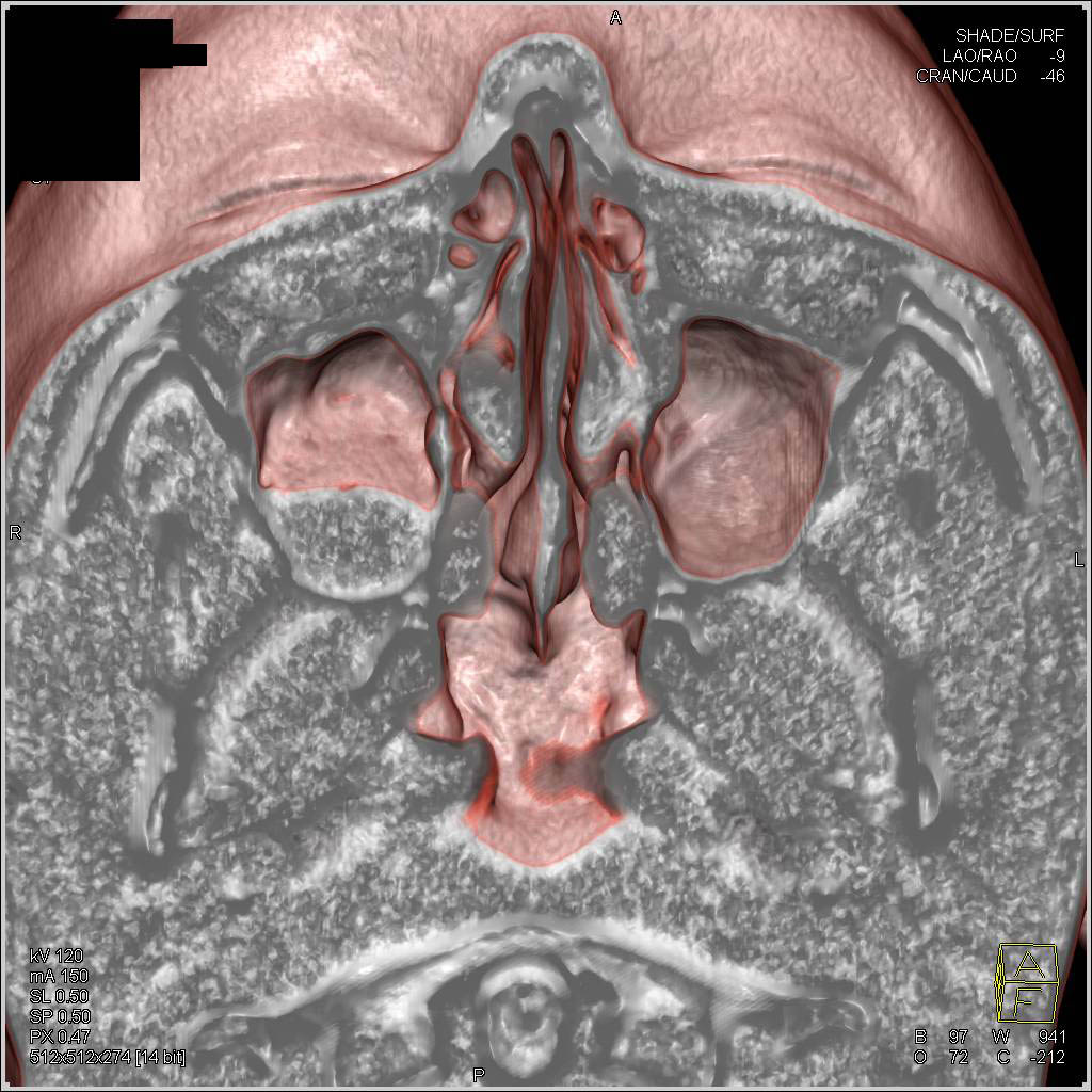 Right Maxillary Sinusitis with Normal Anatomy of the Head and Neck