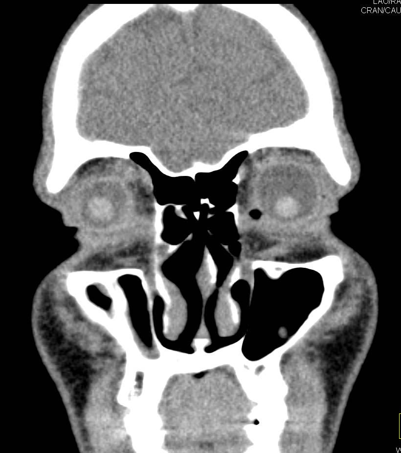 Maxillary Sinusitis - CTisus CT Scan