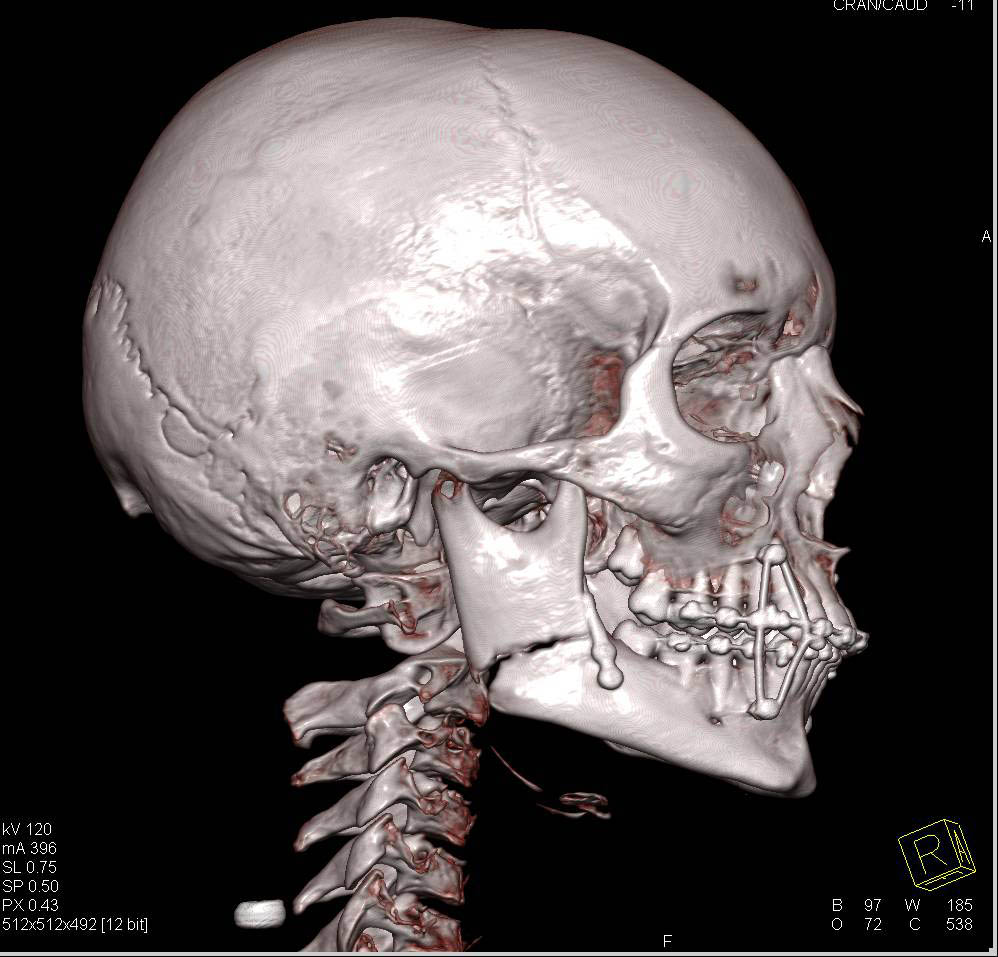 3D Post Repair of Mandibular Fracture - CTisus CT Scan