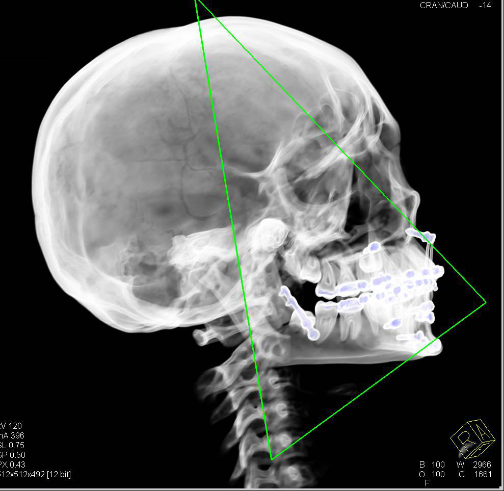 3D Map of Mandibular Fractures Post Repair - CTisus CT Scan