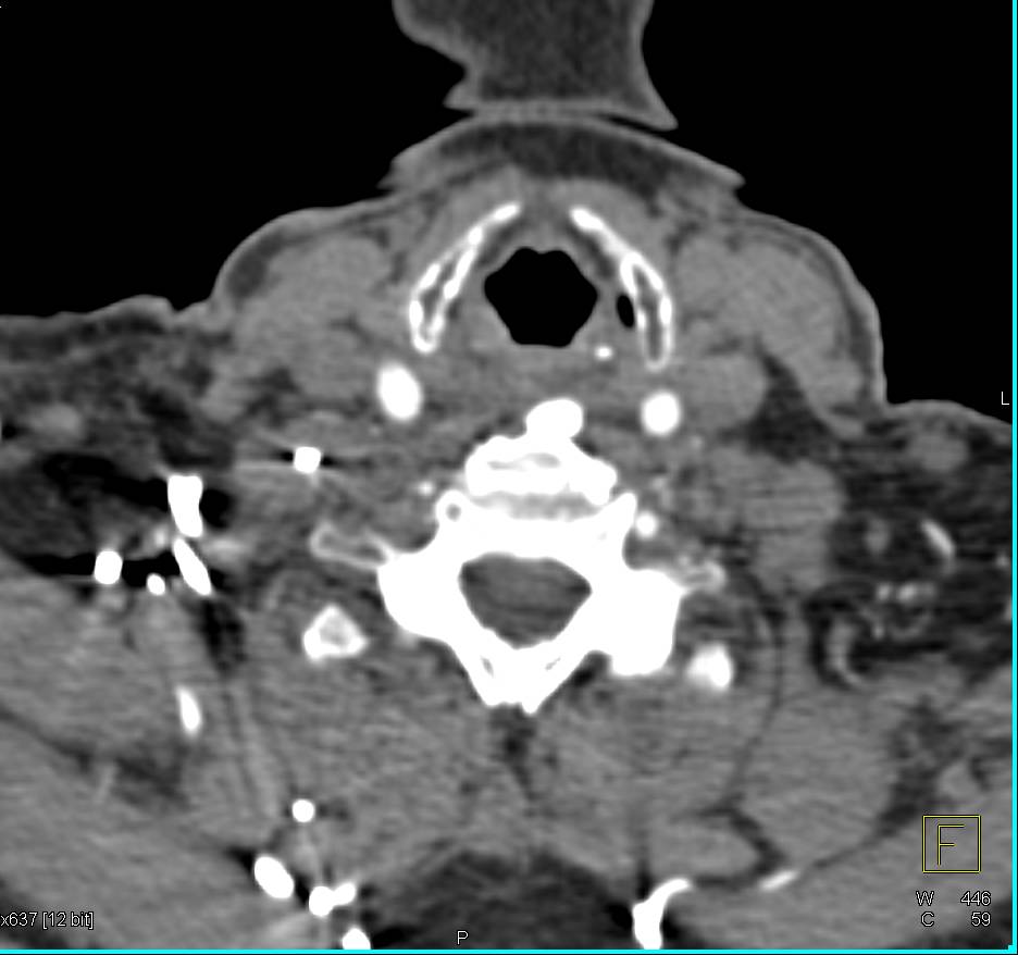 Ectopic Parathyroid Adenoma in Mediastinum - CTisus CT Scan