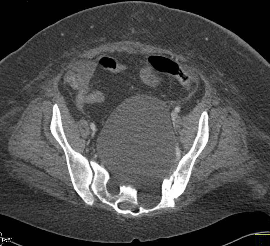 Dural Ectasia with Large Tarlov Cyst Simulates a Pelvic Mass - CTisus CT Scan