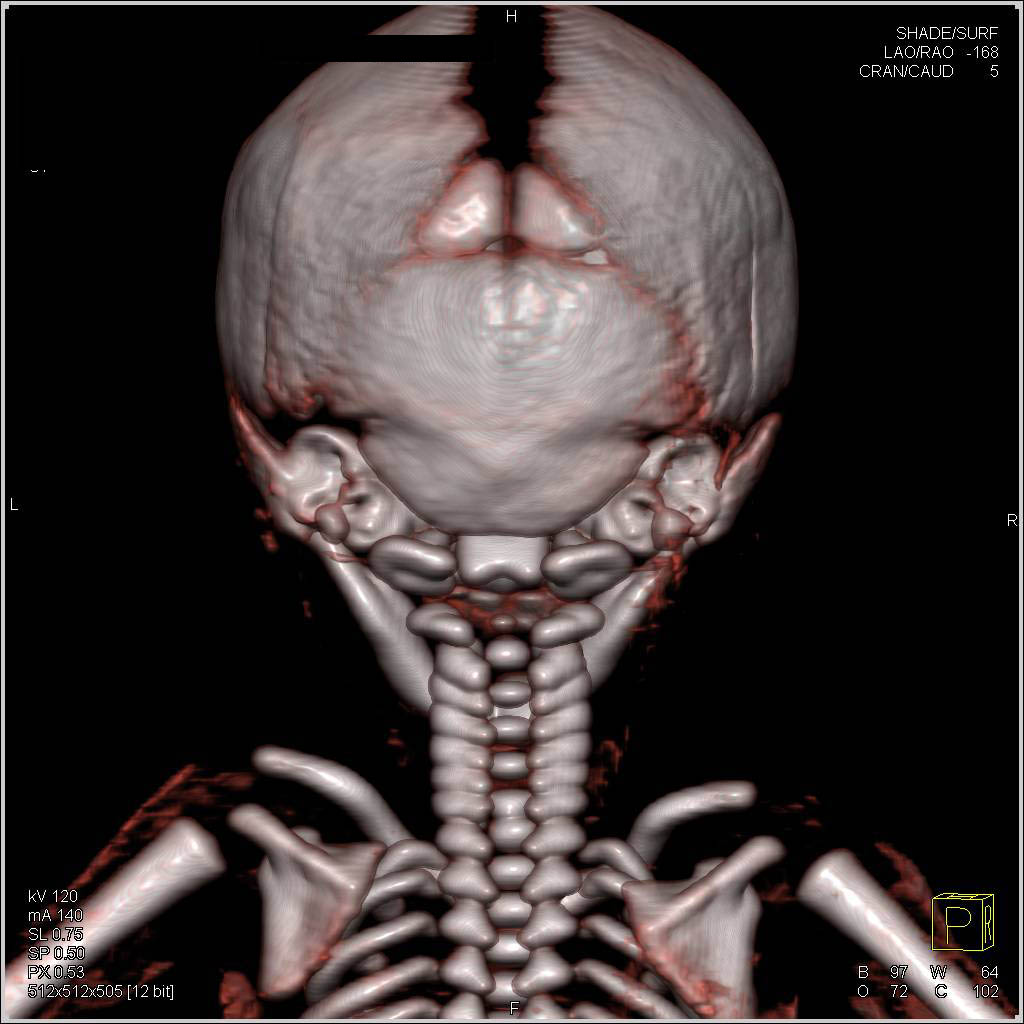 Normal Sutures with no Fusion of Sutures - CTisus CT Scan