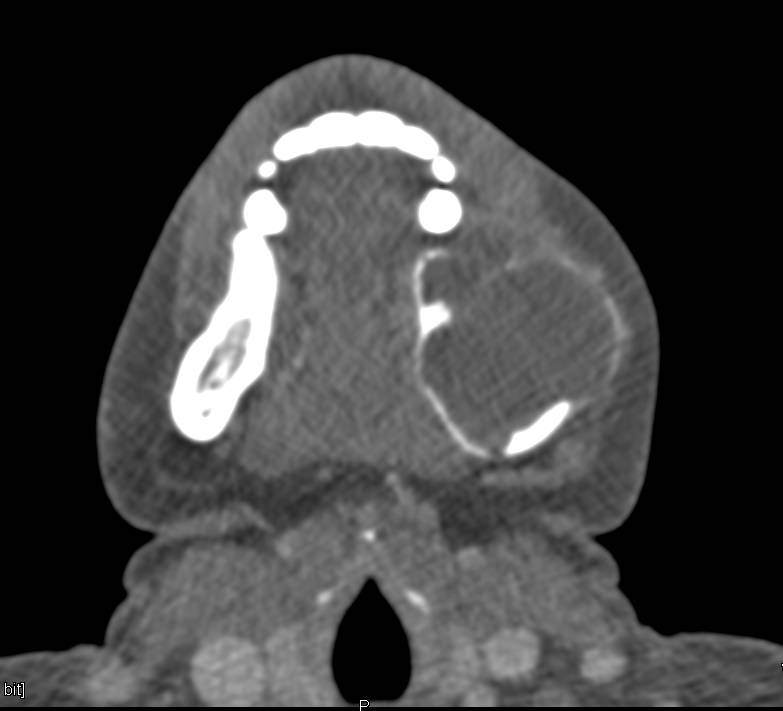 Mandibular Lesion Compatible With a Ameloblastoma - CTisus CT Scan