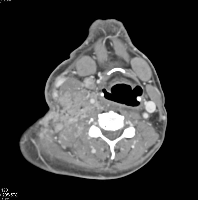 Lymphoma with Extensive Adenopathy in the Neck and Chest with Right Jugular Vein Occlusion - CTisus CT Scan