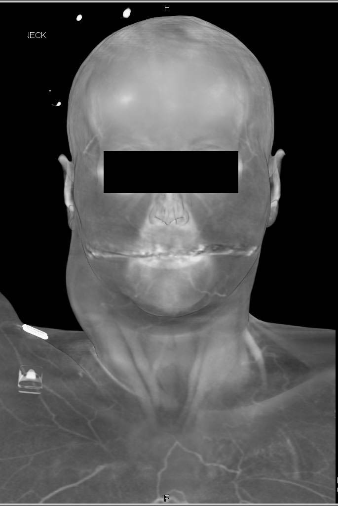 Ehlers-Danlos Syndrome with Large Carotid Artery Aneurysm - CTisus CT Scan