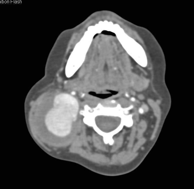 Carotid Artery Aneurysm in Ehlers-Danlos Patient - CTisus CT Scan