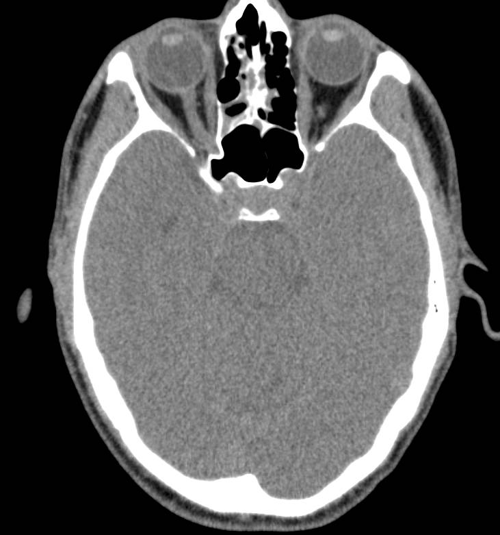 3D of Mucosal Thickening of Maxillary Sinus on Right - CTisus CT Scan