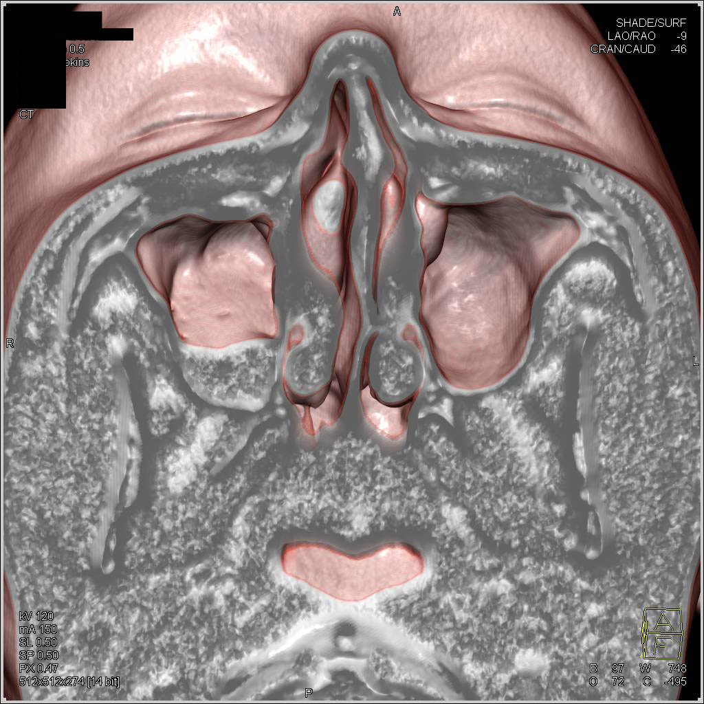 maxillary sinus 3d