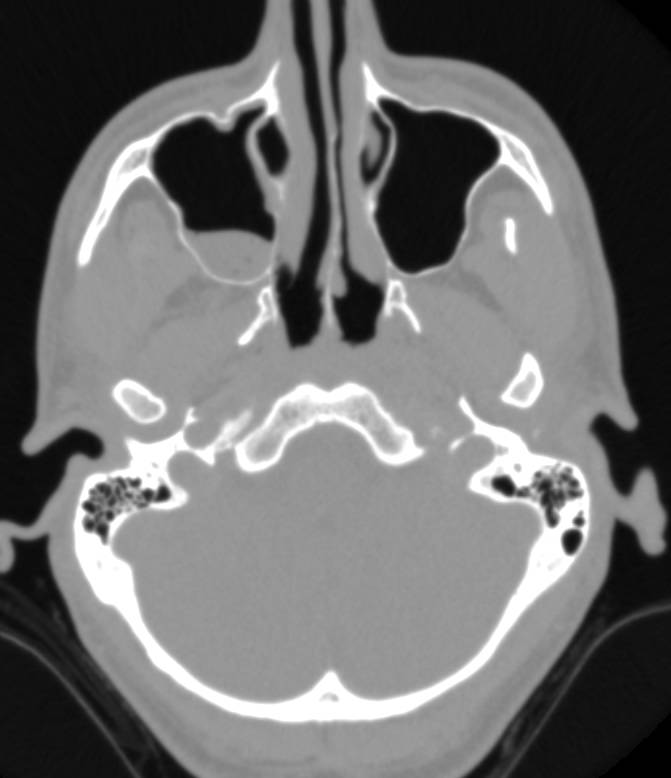 Sinusitis Especially Right Maxillary Sinus - CTisus CT Scan