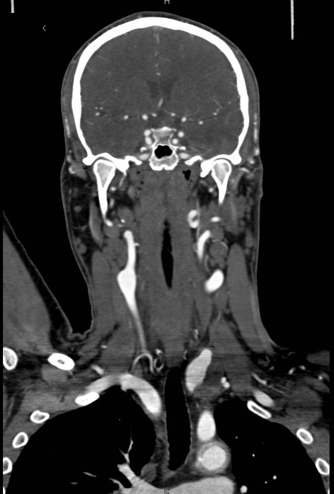 Tortuous Left Internal Carotid Artery on CTA - CTisus CT Scan