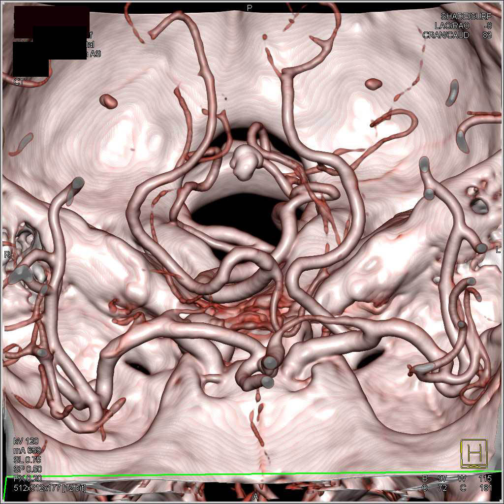 CTA of the Normal Carotid Arteries - CTisus CT Scan