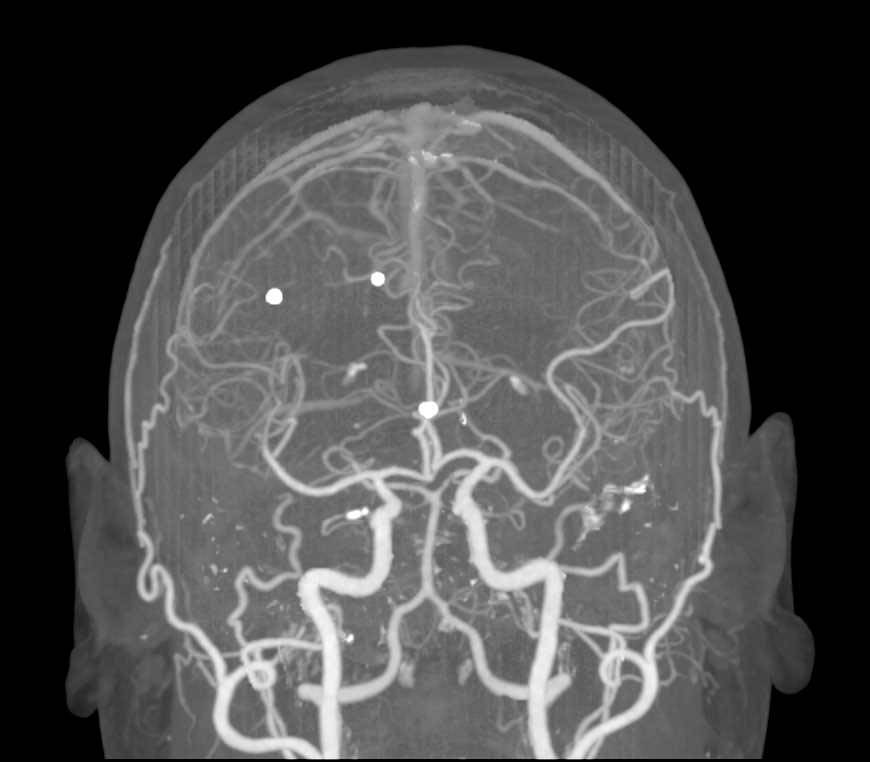 CTA Circle of Willis - Neuro Case Studies - CTisus CT Scanning
