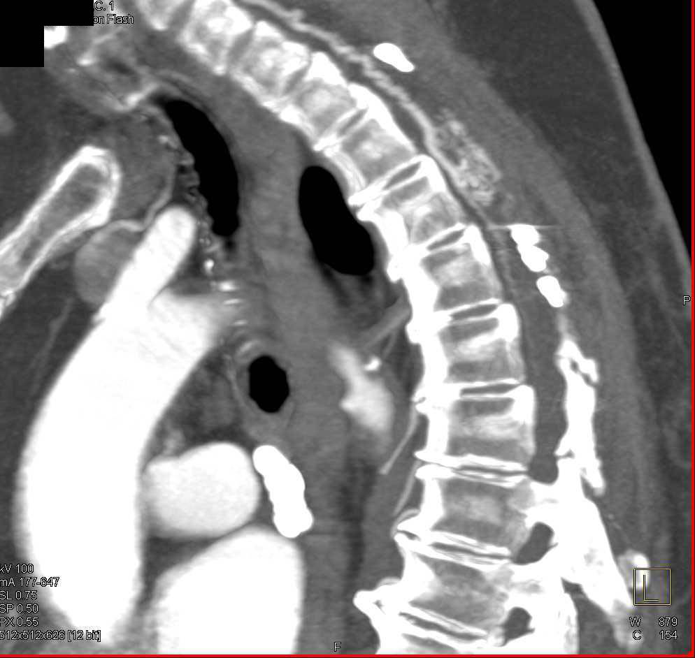 Spinal Arteriovenous Malformation (AVM) - CTisus CT Scan