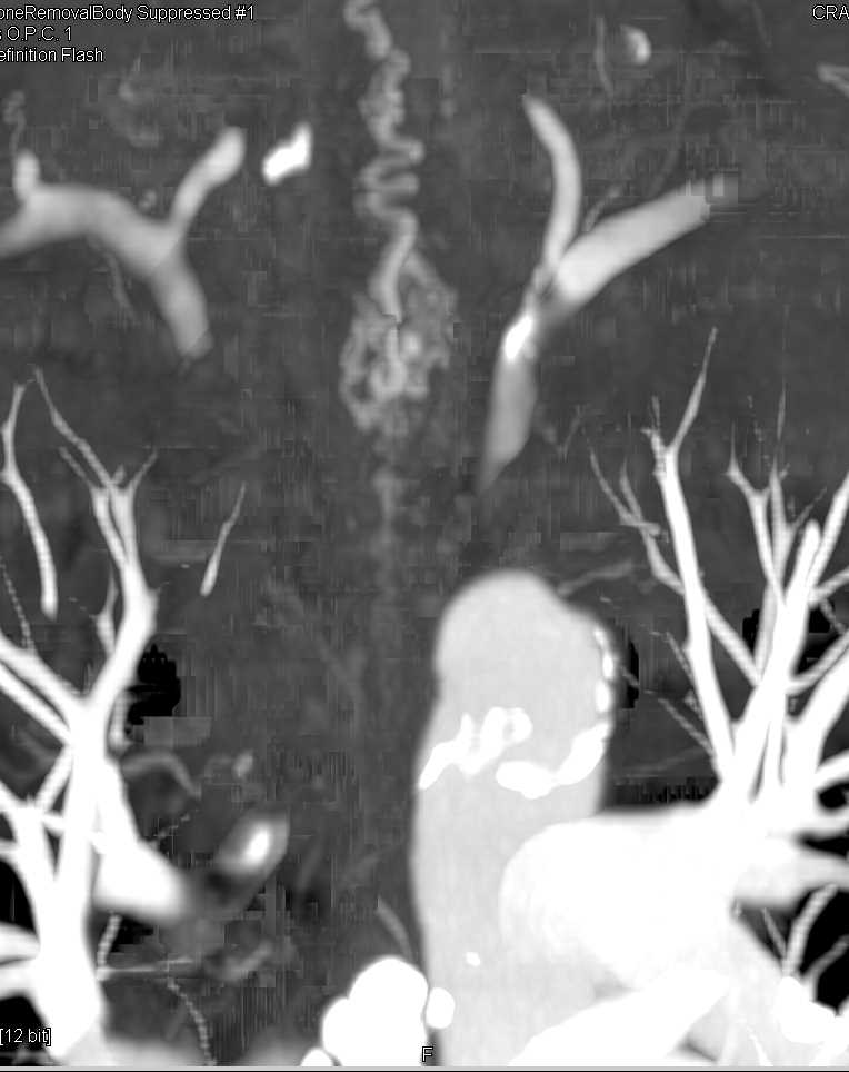 Spinal Arteriovenous Malformation (AVM) Following Bone Removal - CTisus CT Scan