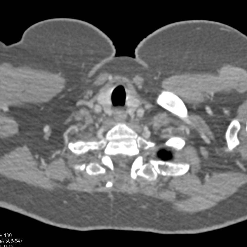 Spinal Arteriovenous Malformation (AVM) Following Bone Removal - CTisus CT Scan