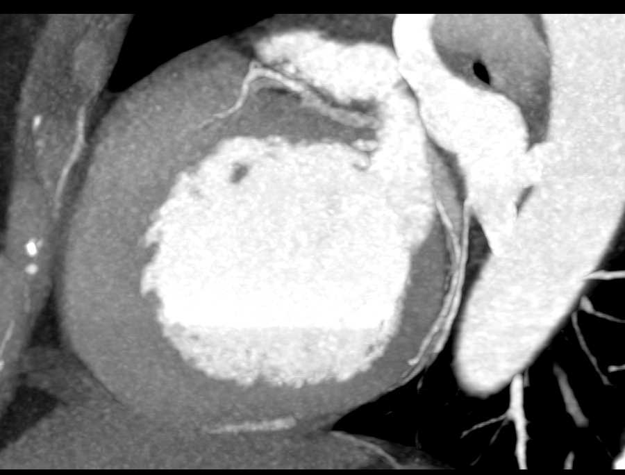 Spinal Arteriovenous Malformation (AVM) Following Bone Removal - CTisus CT Scan