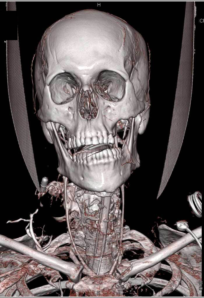 Active Bleed Right Carotid Artery Following GSW - CTisus CT Scan