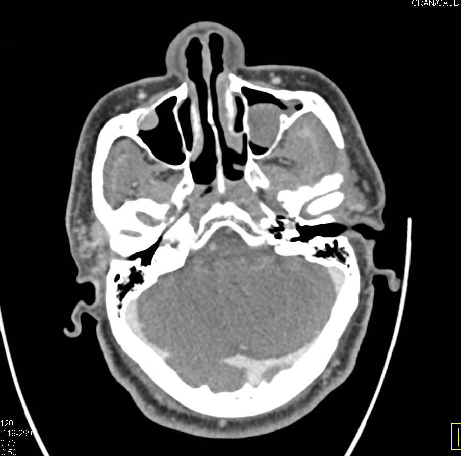 Thyroid Goiter - CTisus CT Scan
