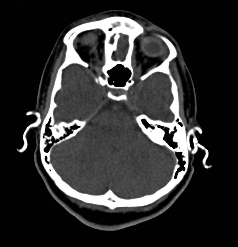 Keutel syndrome (KS) with Cartilage Calcification in the Earlobes - CTisus CT Scan