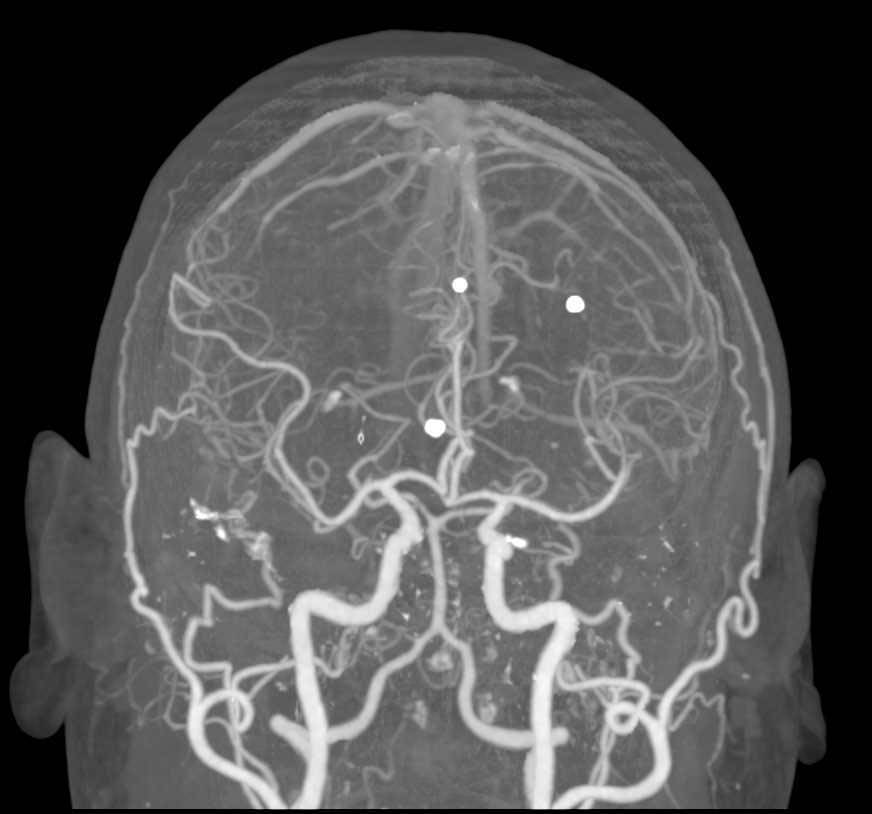 CTA of the Brain - CTisus CT Scan