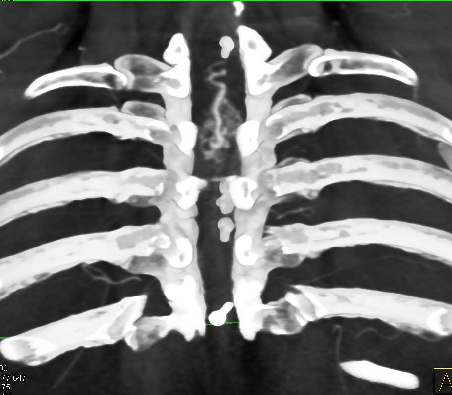 Arteriovenous Malformation (AVM) Spinal Cord - CTisus CT Scan