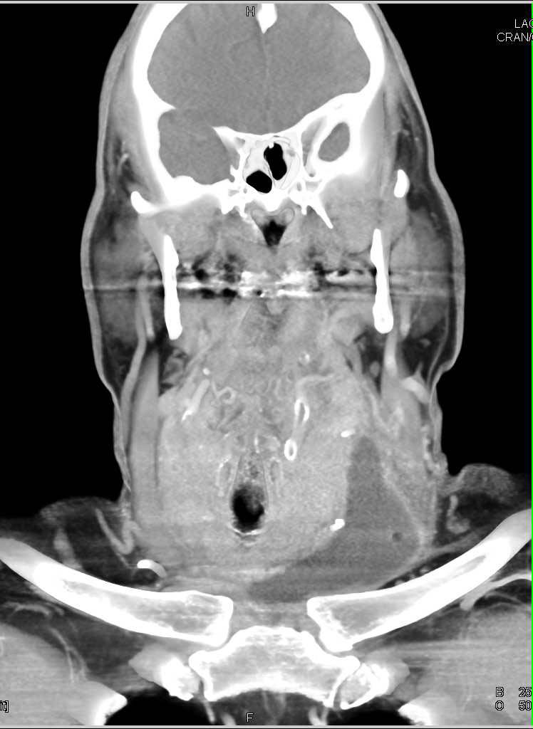 Post Operative Changes Left Neck - CTisus CT Scan