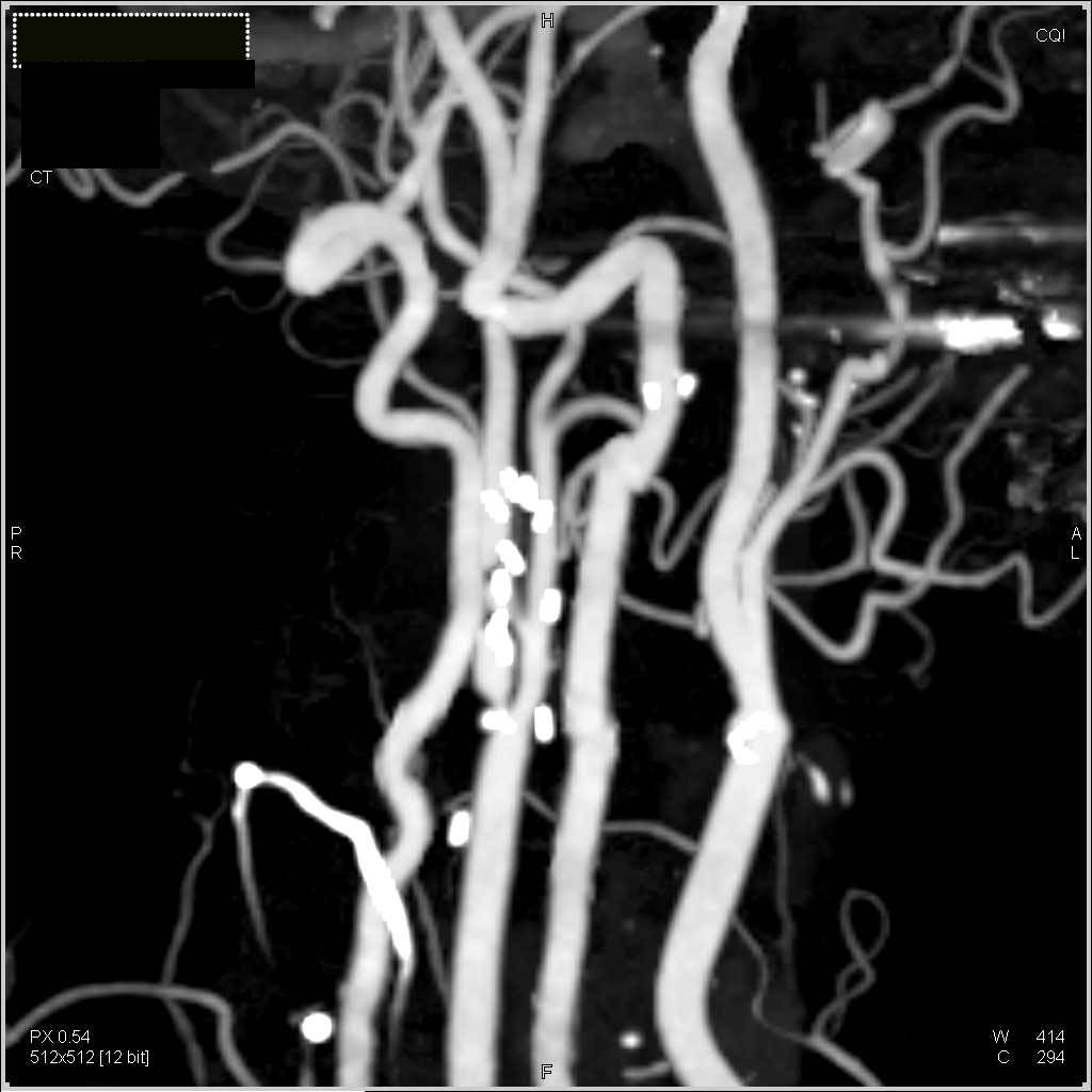 Carotid Artery Stenosis - CTisus CT Scan