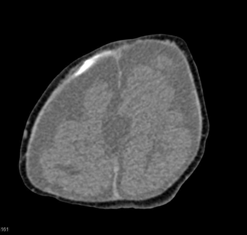 Unusual Case of Cranial Malformation - CTisus CT Scan