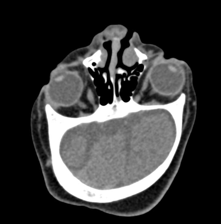 Unusual Case of Cranial Malformation - CTisus CT Scan