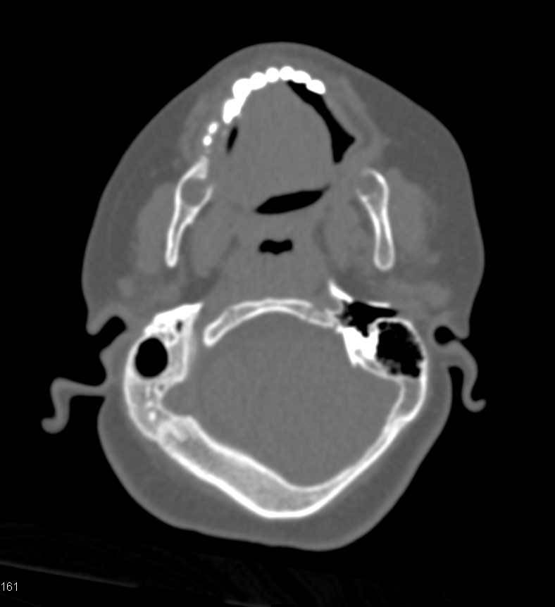 Unusual Case of Cranial Malformation - CTisus CT Scan