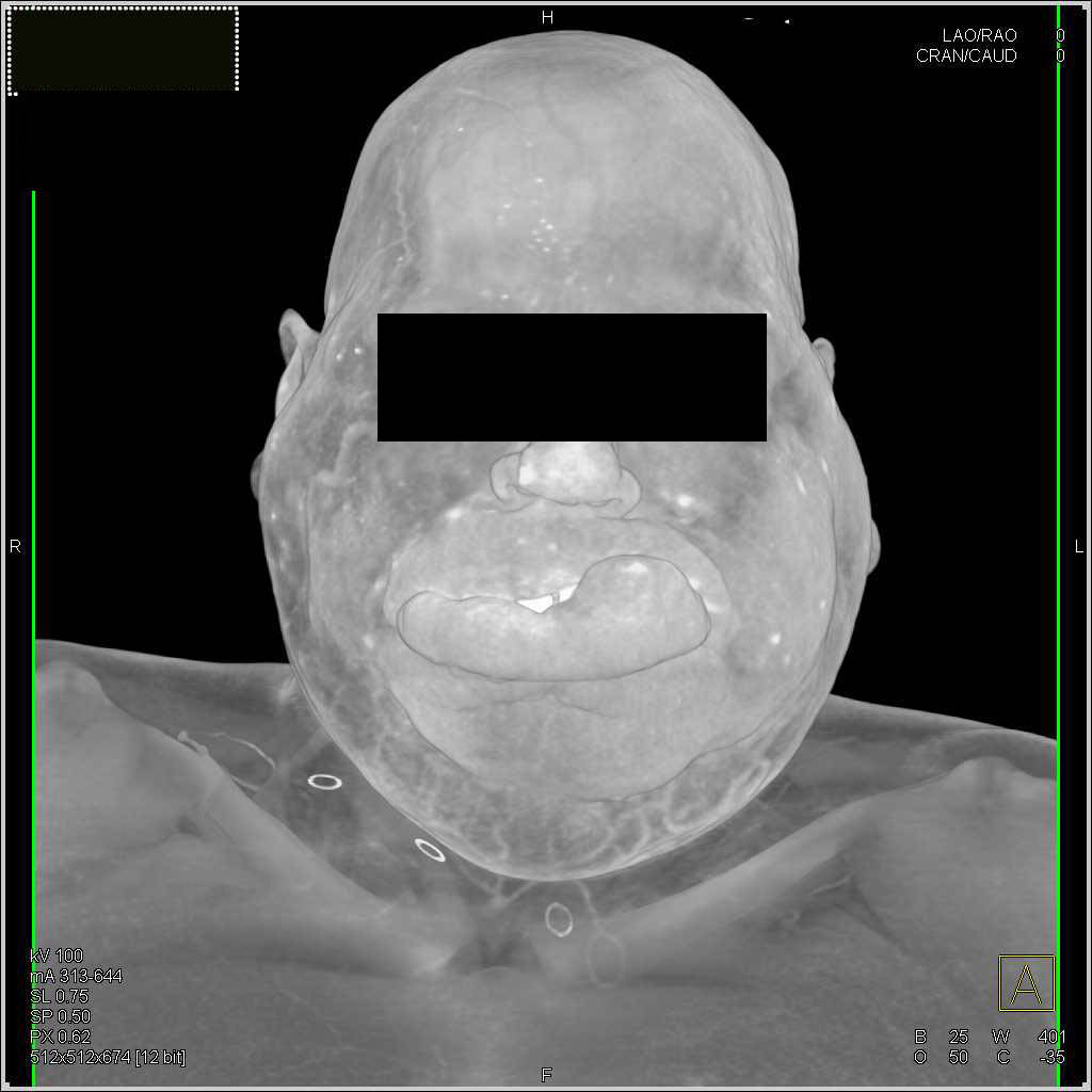 Massively Swollen Head and Neck Region due to Edema - CTisus CT Scan